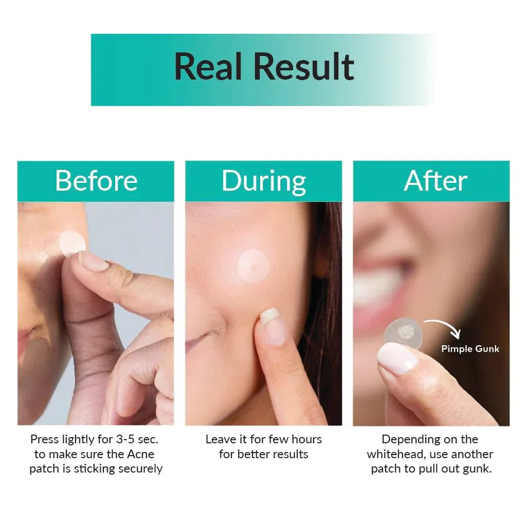 30 Days Miracle Clear Spot Patch [18 pcs] - Image 3